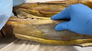 Fasciotomy [upl. by Desai]