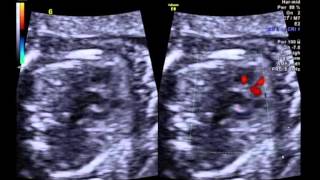 Tetralogy of Fallot with pulmonary atresia 3 vessel view [upl. by Pavkovic]