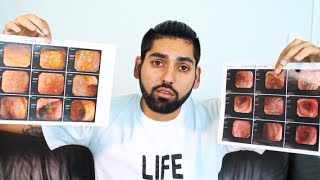 Proof that Ulcerative Colitis can be HEALED CURED amp REVERSED  Heal Ulcerative Colitis [upl. by Ailic]