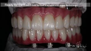 Zirconia Monolithic Full Implant Bridge Tutorial [upl. by Herzel]