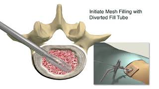 Spineology OptiLIF with the OptiMesh Expandable Interbody Fusion System [upl. by Lever]