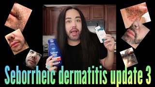 Seborrheic Dermatitis  Update 3 [upl. by Beera]