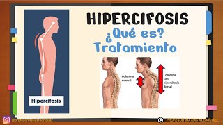 ✅ CIFOSIS e HIPERCIFOSIS dorsal explicación Ejercicios para corregir [upl. by Ludwigg]