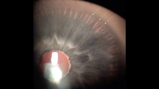 1 Slide in 5 Minutes Pigment Dispersion Syndrome and Pigmentary Glaucoma Malik Y Kahook MD [upl. by Hephzipah553]