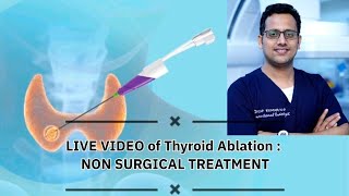 Live Video of Thyroid Ablation  Non Surgical treatment [upl. by Lasonde]