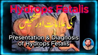 Presentation and Diagnosis of Hydrops Fetalis کی علامات اور تشخیص Hydrops Fetalis [upl. by Karlow]