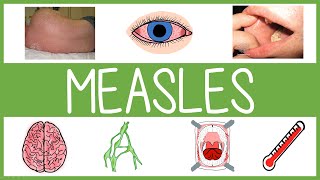 Measles  Features Management and Mnemonics [upl. by Yztim]