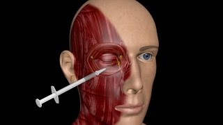 3D MEDICAL TRAINING PROGRAM  BLEPHAROSPASM TREATMENT [upl. by Idoux771]