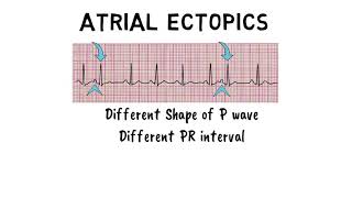 ATRIAL ECTOPICS [upl. by Yla]