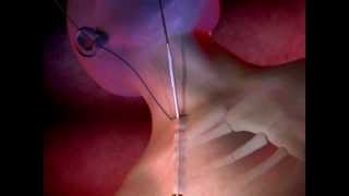 ProGuide™ Chronic Dialysis Catheters Animation [upl. by Maillliw465]