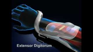 Bioness NESS H200 Hand Rehabilitation System Overview Rx Only [upl. by Ahsemat]