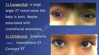 A one hour lecture of Exotropia By Dr Sameera [upl. by Griffy]