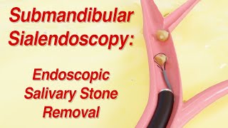 Submandibular Sialendoscopy Endoscopic Salivary Stone Removal [upl. by Hunfredo]