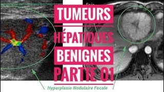 Tumeurs Hépatiques Benignes  partie 01 Angiome Hyperplasie Nodulaire Focale [upl. by Zetta]