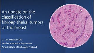 An update on the classification of fibroepithelial tumors of the breast [upl. by Scholem]