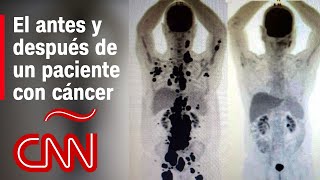 Antes y después de un paciente con cáncer que tuvo remisión en 1 mes gracias a terapia de células [upl. by Rosalee92]