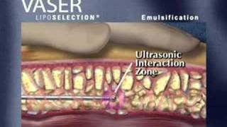 VASER Technique Overview [upl. by Anauq184]