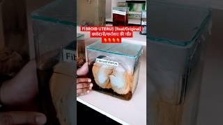 Fibroid uterus  बच्चेदानी की गाँठ । Uterine myoma [upl. by Natsyrk]