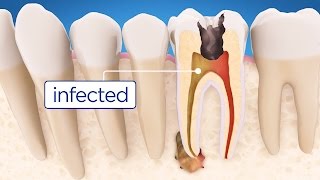 Root Canal Treatment Step by Step [upl. by Erapsag]