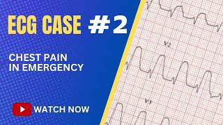 ECG Case 2 Chest Pain in Emergency Department [upl. by Hedy933]