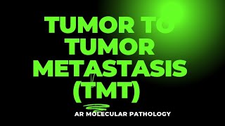 tumor to tumor metastasis TMT MUC16ekdinkarajapathologynotes AR Molecular pathology [upl. by Akkinahs814]