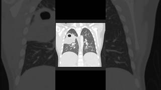 HRCT Chest Necrotizing pneumonia viralreels [upl. by Phillipe]