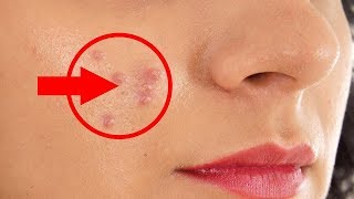 How to Remove Pimples Overnight  Beauty Tips in Tamil [upl. by Regor254]