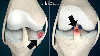 Is your knee pain coming from an ACL tear or Meniscus injury How to tell [upl. by Leduar]