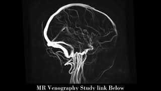 MR venography [upl. by Yhtir]