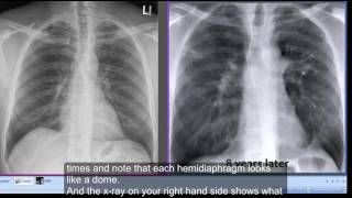 Chest xray Tenting of hemidiaphragms [upl. by Orv163]