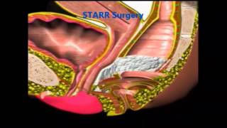 Lucky STAPLED Transanal Rectal Resection STARR Surgery for Constipation treatment [upl. by Winnick]