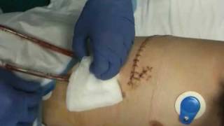 Rideys chest tube removal [upl. by Luing]