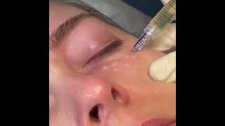 MicronJetTM in Action Intradermal Delivery of Aesthetic Product to the Preorbital Under Eye Area [upl. by Atiloj300]