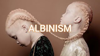 albinism [upl. by Oakie]