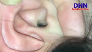 Blackheads Removal Biggest Nose ExtractionBlackhead Popping in Ear [upl. by Anahahs]