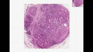 Histopathology Lymph node  Adenocarcinoma metastatic to l [upl. by Oiceladni]