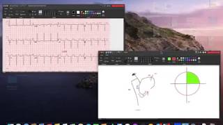 Left Anterior Fascicular Block LAFB  Left Anterior Hemiblock ECG [upl. by Noman]