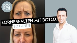 ZORNESFALTE mit BOTOX behandeln – darauf muss man achten Dr Rolf Bartsch [upl. by Athena]