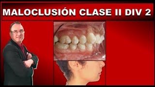 MALOCLUSION CLASE 2 DIVISION 2 DE ANGLE  ORTODONCIA [upl. by Gamali]