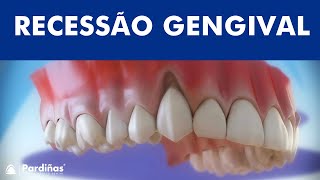 Recessão gengival  Tratamento da retração da gengiva © [upl. by Kinsler]