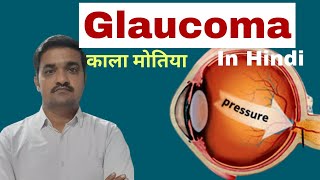 Glaucoma bsc nursing 3rd year  Type symptoms surgery  glaucoma  Nursing Lecture in hindi [upl. by Ludba311]