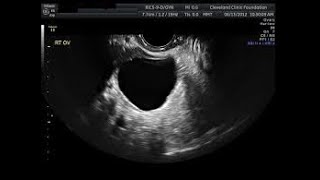 Management of postmenopausal ovarian cyst [upl. by Aratal349]