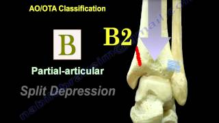 Pilon Fracture Tibial Plafond Fracture  Everything You Need To Know  Dr Nabil Ebraheim [upl. by Aubyn]