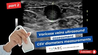 Part 2 Varicose veins ultrasound assessment great saphenous vein diameters measurements [upl. by Tonry862]