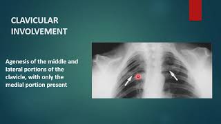 CLEIDOCRANIAL DYSPLASIA  Xray  Radiology [upl. by Ime]