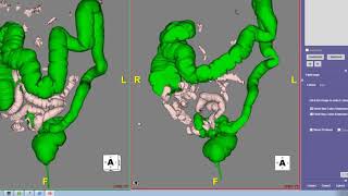 CT Colonography [upl. by Pet220]