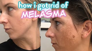 How I Got Rid of my Melasma aka Pregnancy Dark Spot [upl. by Croydon]