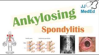 Ankylosing Spondylitis  HLAB27 Pathophysiology Signs amp Symptoms Diagnosis Treatment [upl. by Stamata]