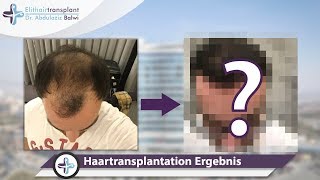 Haartransplantation Vorher Nachher  Ergebnis nach 12 Monaten [upl. by Barcot]