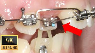 ❤️‍🔥 PIGGYBACK step by step double wire technique and ODONTOMA in Crossbite Case 4K Video [upl. by Zaller57]